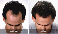 Hair Transplant Lebanon Mondial Hair Transplant